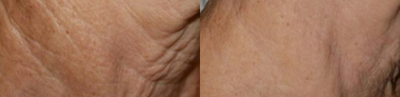 Nonsurgical Neck Lift before and after photo