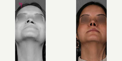 Rhinoplasty before and after photo