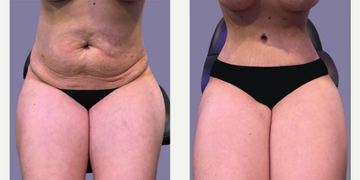 Tummy Tuck before and after photo