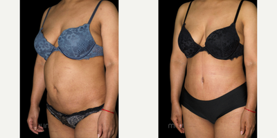 Tummy Tuck before and after photo