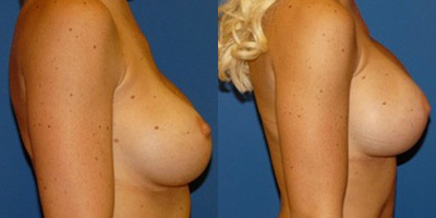 Breast Implant Revision before and after photo