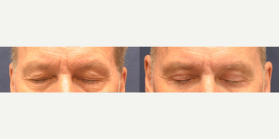Eyelid Surgery before and after photo