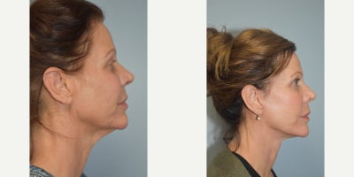Eyelid Surgery before and after photo
