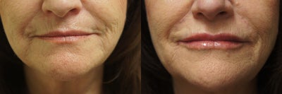 Lip Fillers before and after photo