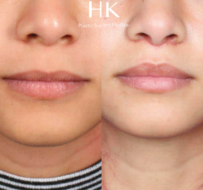 Lip Lift before and after photo