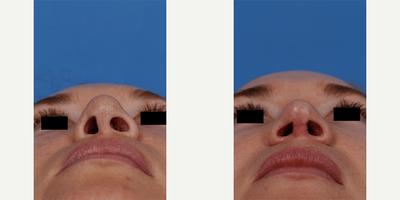 Revision Rhinoplasty before and after photo