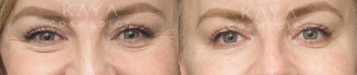 Botox before and after photo