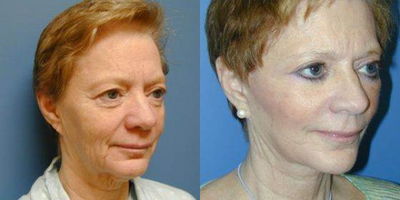 Facelift before and after photo