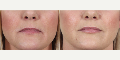 Juvederm before and after photo