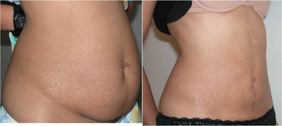 Liposculpture before and after photo