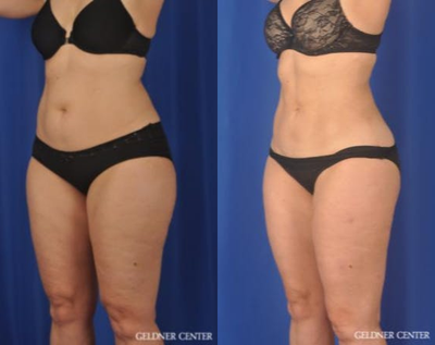 Liposuction before and after photo