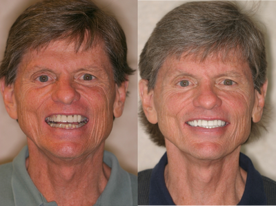 Smile Makeover before and after photo