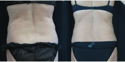 CoolSculpting before and after photo