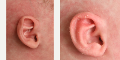 Ear Surgery before and after photo