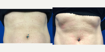Emsculpt before and after photo
