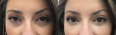 Eyelid Surgery before and after photo