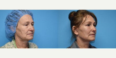 Facelift before and after photo