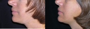 Facelift before and after photo