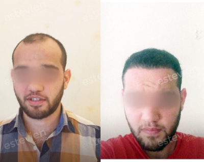 Hair Loss Treatment before and after photo