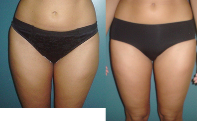 Liposculpture before and after photo