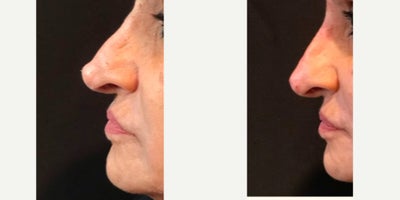 Nonsurgical Nose Job before and after photo