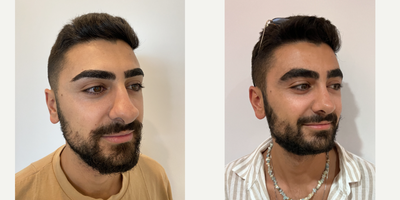 Septoplasty before and after photo