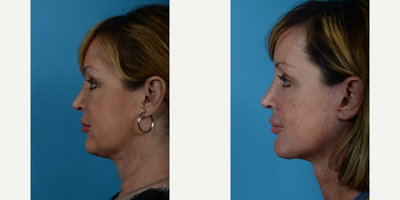 Chemical Peel before and after photo