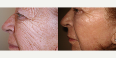 CO2 Laser before and after photo