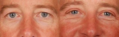 Eyelid Surgery before and after photo