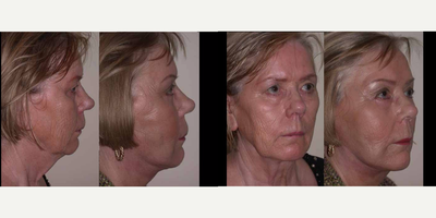 Facelift before and after photo