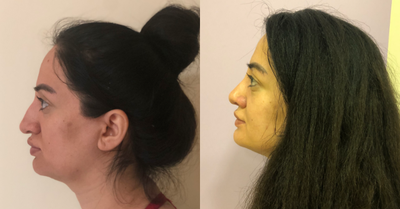 Rhinoplasty before and after photo