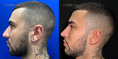 Rhinoplasty before and after photo