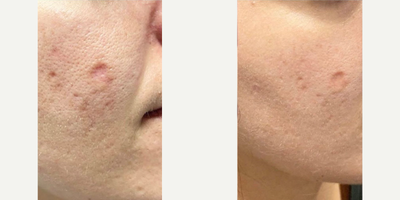 SkinPen before and after photo