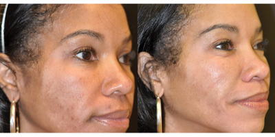 Chemical Peel before and after photo