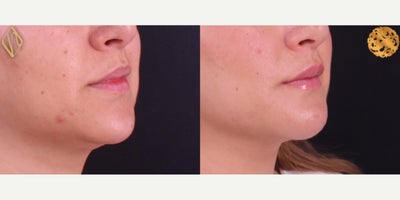 Chin Liposuction before and after photo