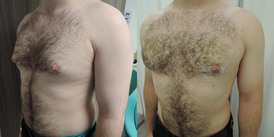 Gynecomastia Surgery before and after photo