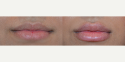 Lip Fillers before and after photo