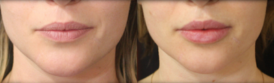 Lip Fillers before and after photo