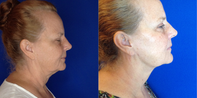 AccuTite before and after photo