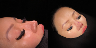 African American Rhinoplasty before and after photo