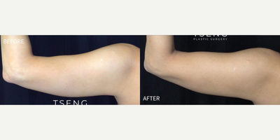 Emsculpt before and after photo