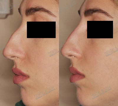 Nonsurgical Nose Job before and after photo