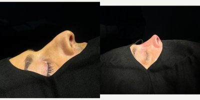 Rhinoplasty before and after photo