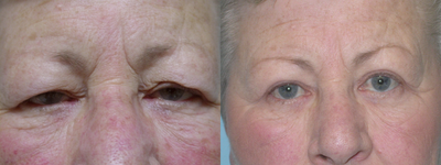 Eyelid Surgery before and after photo