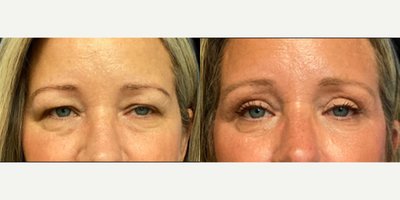 Eyelid Surgery before and after photo