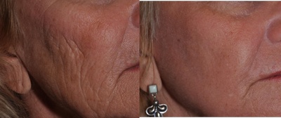 Fractional Laser before and after photo