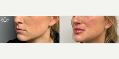 Lip Fillers before and after photo