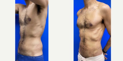 Liposuction before and after photo