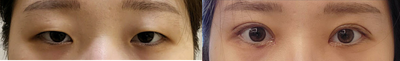 Ptosis Surgery before and after photo