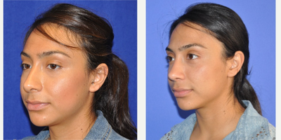 Revision Rhinoplasty before and after photo